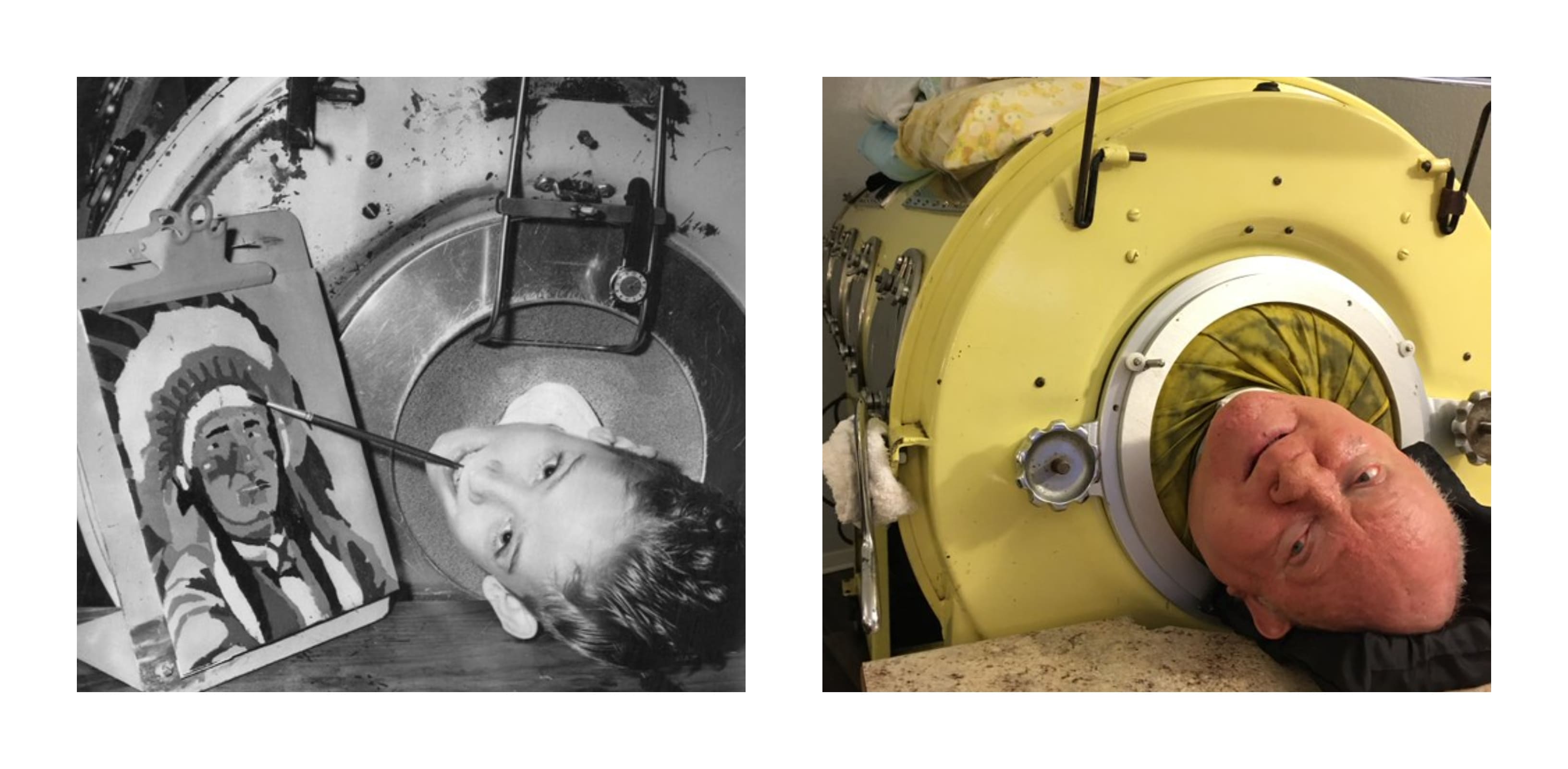 Texas Man Who Lived Seven Decades In Iron Lung Dies At Age 78 2662